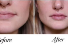 how much is lip filler