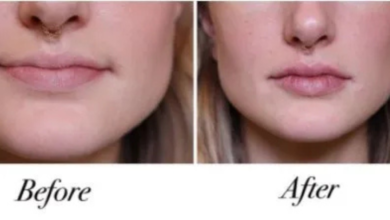 how much is lip filler