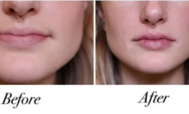 how much is lip filler